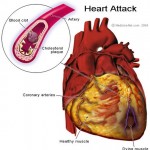 srčani-udar