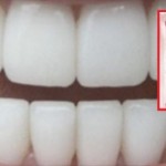 zubi-ciscenje-620x324