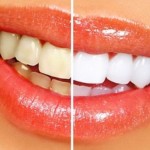 bijeli-zubi