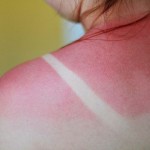 SPRŽILI STE SE NA SUNCU? Napravite ove kuglice i olakšajte muke!