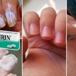 nokti-aspirin